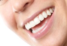 Porcelain Veneers